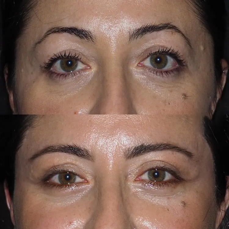 Eye bag removal in Dubai: The Role of Skin Care in Recovery