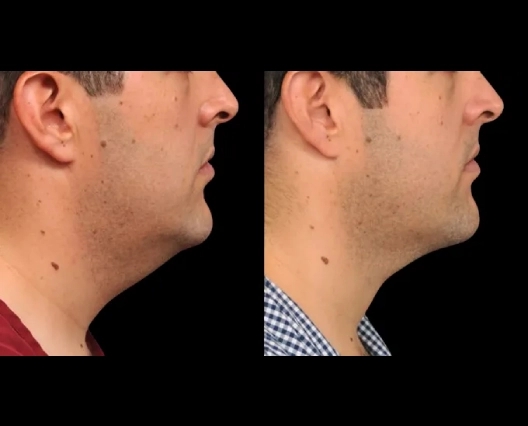 Non-Invasive Double chin removal in Dubai: What You Need to Know