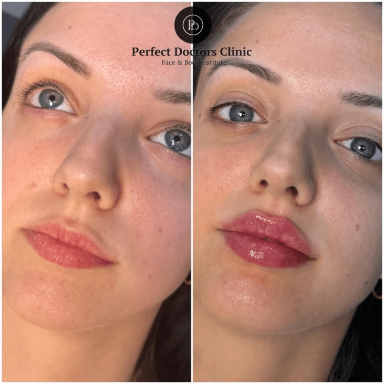 Juvederm Results You’ll Love with the Best Doctors in dubai